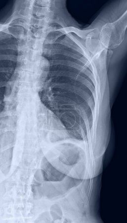 Foto de Radiografía costal de costa, esternón y clavícula que muestra una infracción de la octava costilla a la izquierda - Imagen libre de derechos