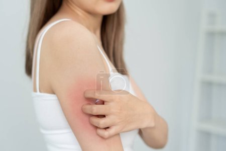 Téléchargez les photos : Skin problem and beauty. Young woman scratch body has itchy skin from skin allergic, steroid allergy, sensitive skin, red from sunburn, chemical allergy, rash, insect bites, Seborrheic Dermatitis. - en image libre de droit