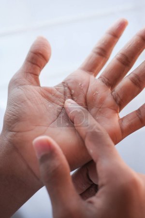 close up of Dry cracked skin of a mens hand ,