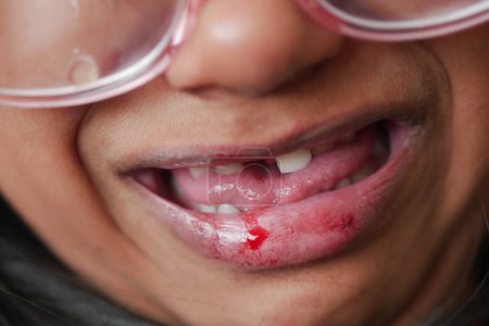 Téléchargez les photos : Gros plan de la lèvre sèche d'un enfant , - en image libre de droit