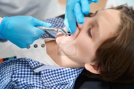 Téléchargez les photos : Garçon se fait enlever une dent dans une clinique dentaire avec un outil spécial, le médecin travaille avec des gants - en image libre de droit
