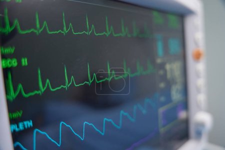 Foto de Foto de primer plano de un monitor de paciente con lecturas de frecuencia cardíaca para monitorear la condición del paciente - Imagen libre de derechos
