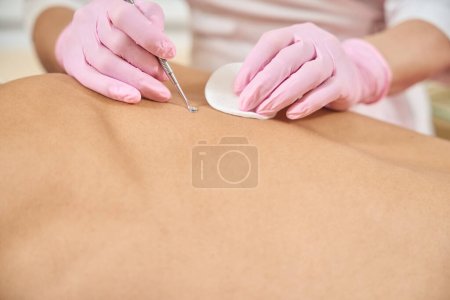 Photo for Beautician cleanses clients back skin, she uses uno spoon - Royalty Free Image