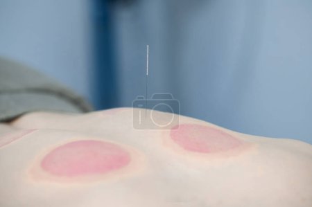 Photo for Acupuncture. Man having acupuncture in a rehabilitation center - Royalty Free Image