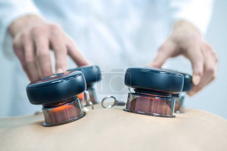 Photo for Back treatment. Doctor putting medical cups on his patients back - Royalty Free Image