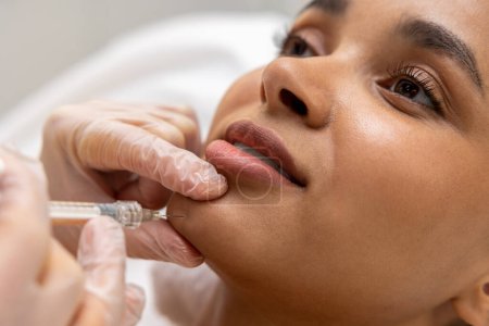 Foto de Cuidado de los labios. Mujer de piel oscura que se inyecta ácido hialurónico en los labios - Imagen libre de derechos