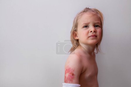 Foto de Niño pequeño con herida quemada en la mano, escaldaduras y quemaduras en un niño, espacio vacío - Imagen libre de derechos