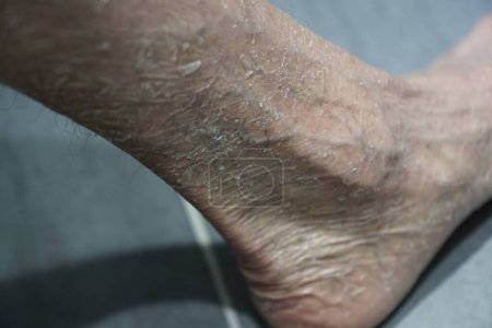 Téléchargez les photos : Foot of a man with the skin disease Ichthyosis - en image libre de droit