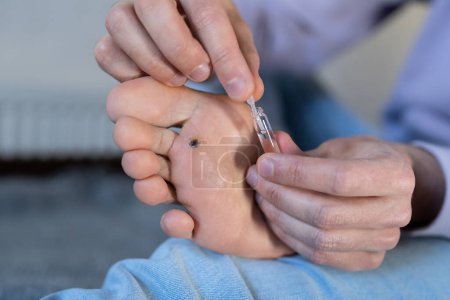 Photo for Alternative home treatment of verruca foot. Man applying liquid celandine extract on the wart plantar of his foot. Human papilloma callus virus or HPV, viral skin infection concept. - Royalty Free Image