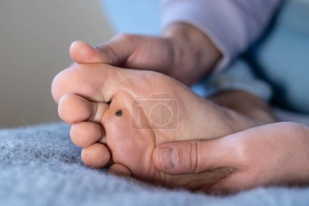Photo for Man checks wart at home after cauterizing it with celandine on infected foot. Human papillomavirus or HPV. Verrucas papilloma callus virus. Viral skin infection concept. - Royalty Free Image