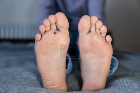 Photo for Man shows two feet. One with healthy skin, second with plantar wart after cauterization with celandine extract. Alternative home treatment for warts. Human papillomavirus or HPV concept. - Royalty Free Image