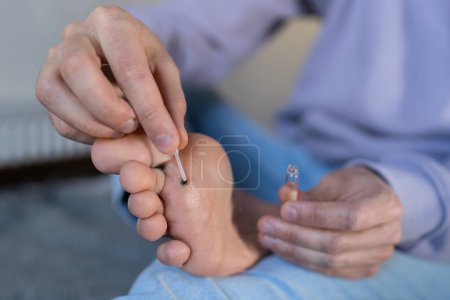 Photo for Alternative home treatment of verruca foot. Man applying liquid celandine extract on the wart plantar of his foot. Human papilloma callus virus or HPV, viral skin infection concept. - Royalty Free Image