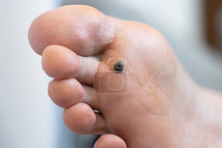 Photo for Closeup of dead skin around wart plantar after cauterizing it with celandine on infected foot. Hygiene, human skin disease, papillomavirus or HPV concept. Self-medication. - Royalty Free Image