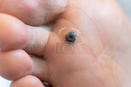 Foto de Closeup of dead skin around wart plantar after cauterizing it with celandine on infected foot. Hygiene, human skin disease, papillomavirus or HPV concept. Self-medication. - Imagen libre de derechos