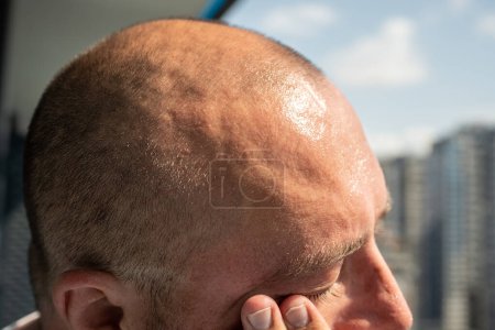 Photo for Forehead of overheated man becomes covered with sweat outdoors in hot climate in stuffy, windless weather with scorching sun. Exhausted male feeling unwell in heat having high blood pressure, headache - Royalty Free Image
