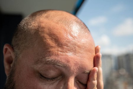 Photo for Man forehead, sunstroke, sweat on face, bald head. Close up. Guy suffers from heat, high temperature and humidity, pressure, being in hot scorching summer sun at balcony, overheating superheating - Royalty Free Image