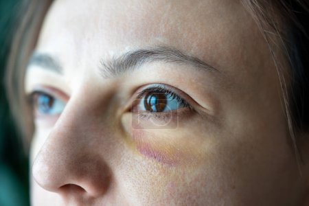 Photo for Beaten abused helpless scared wife with eye hematoma experiencing domestic violence, aggression, harassment, rudeness, bullying from husband. Female having black eye, trauma caused by accident fall - Royalty Free Image