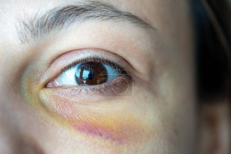Photo for Close-up eye bruise hematoma of young woman suffered from domestic violence. Part of female victim injured face. Abuse, tyranny, human cruelty intimidation, physical violence, aggression concept. - Royalty Free Image