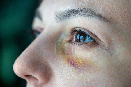 Photo for Injured wife with bruise under eye suffering domestic violence, aggression, bullying, unhappy relationship. Cropped image of hematoma on female face. Woman having accident fall, trauma, injury at home - Royalty Free Image