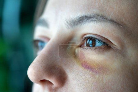 Photo for Beaten up female worried face with bruised black eye from fight blow. Sad woman suffered from domestic violence looks sadly out window. Abusive relationship with husband, tyranny at home. Needs help - Royalty Free Image