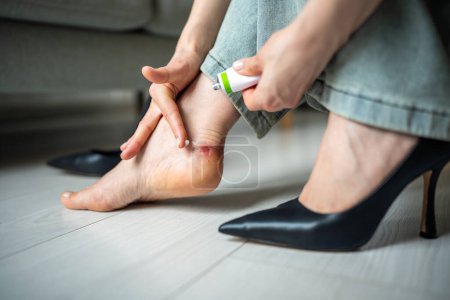Closeup of woman nursing blistered heel with healing balm. Traumatised skin, callus from uncomfortable shoes with heels. Treatment of chafed foot. Discomfort, recovery, soreness, sensitivity, skincare