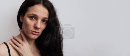 Close-up of a young woman with acne on her face and skin problems. A panoramic shot on the banner. a place for your text.