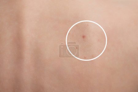 Close-up of the back skin of a woman with acne and other dermatological problems