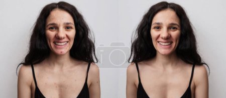 Une jeune femme avant et après le traitement de l'acné sur un fond beige.
