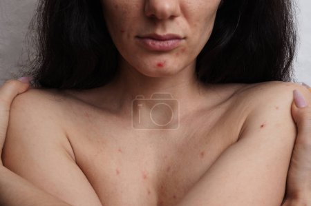 Close-up of the skin of the face and body of a woman with acne and other dermatological problems
