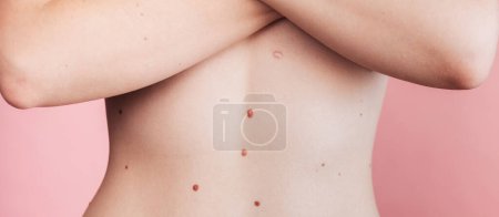 Téléchargez les photos : Le ventre d'une femme avec de nombreuses taupes. L'effet du soleil sur la peau. Cancer de la peau. Le panorama - en image libre de droit
