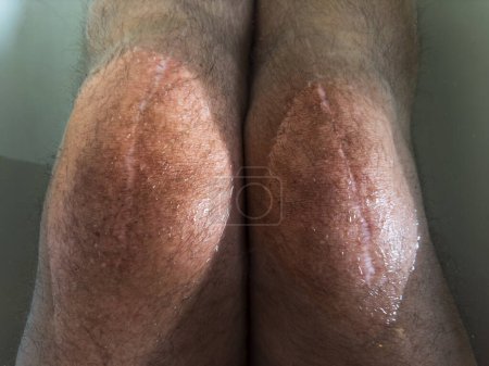 Photo for Senior with total knee knee replacement sitting in the bath - Royalty Free Image