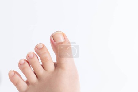 ingrown toenail on a childs foot, medical issue, discomfort, white background