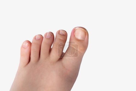 edge of the toenail grows into the surrounding skin, causing pain, swelling, and potentially leading to infection