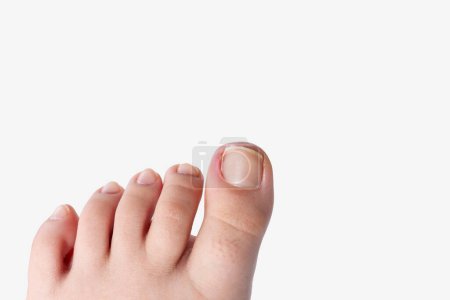 Eingewachsene Zehennägel, die die Haut umgeben, Schmerzen verursachen, Schwellungen verursachen und möglicherweise zu Infektionen führen, Tamponade im medizinischen Kontext, weißer Hintergrund, Vorderansicht