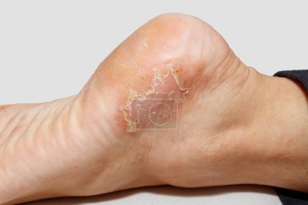 Dyshidrotic eczema skin disease on foot heel against white background.