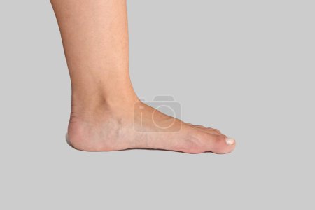 Photo for Flat foot of woman showing missing arch which can cause misalignment and orthopedic problems on white background. - Royalty Free Image