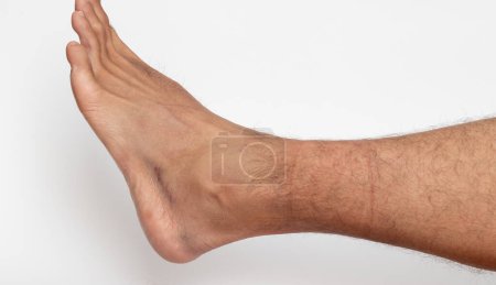Sprained ankle and bruise contused wound on foot skin on white background.