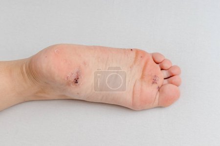 Plantar wart on heel of female foot caused by hpv or human papilloma virus.
