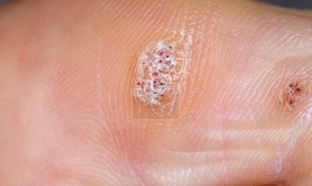 Verrugas plantares se cierran en la parte inferior de un dedo gordo del pie causado por el virus del papiloma humano, o VPH.