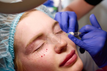 Foto de El cosmetólogo inyecta sustancia en la cara que modifica al paciente para hacer la corrección no quirúrgica. Inyecciones de relleno. Concepto de tratamientos correctivos estéticos. - Imagen libre de derechos