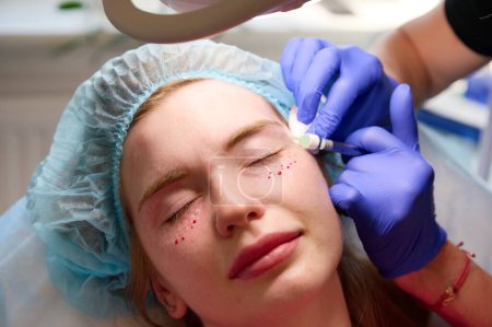 Kosmetologe injiziert Substanz in Patienten, die Gesicht modifizieren, um nicht-chirurgische Korrekturen vorzunehmen. Füllstoffspritzen. Konzept ästhetischer Korrekturbehandlungen.