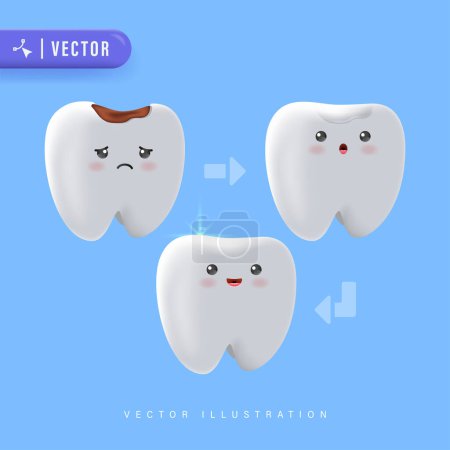 Step of Tooth Filling Illustration Vector on Blue Background. Dental Care Concept. Treatment Of Caries.