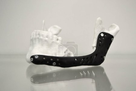 Photo for 3D printed plastic prototype human lower jaw and medical titanium implant close-up. Black prosthesis prototype anatomical human bone 3D printed from metal powder. Orthopedic maxillo-facial prosthesis - Royalty Free Image
