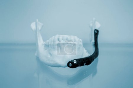 Photo for 3D printed plastic prototype human lower jaw and medical titanium implant close-up. Black prosthesis prototype anatomical human bone 3D printed from metal powder. Orthopedic maxillo-facial prosthesis - Royalty Free Image