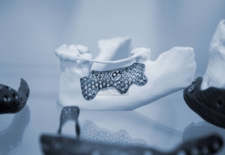 Photo for Facial bone of lower human jaw individual prosthesis printed on 3D printer from metal powder. Medical titanium prototype of jaw bone created by powder 3D printer. Implantation of endoprosthesis - Royalty Free Image
