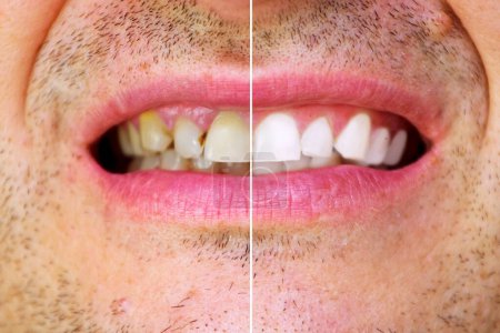 Téléchargez les photos : Smile with whitening teeth before and after - en image libre de droit