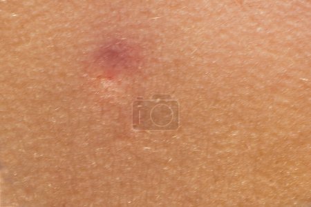 Foto de Primer plano de una picadura de insecto en la piel. Reacción alérgica. Inflamación cutánea. Enfermedades y tratamiento de enfermedades de la piel - Imagen libre de derechos
