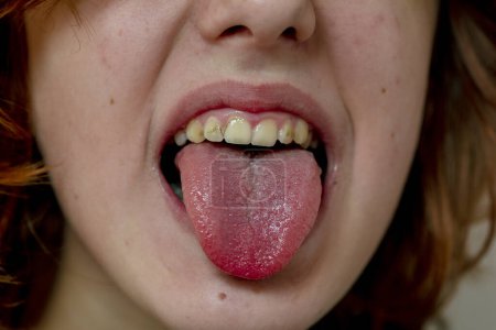 Teenager-Mädchen öffnet beim Husten den Mund und streckt die Zunge heraus