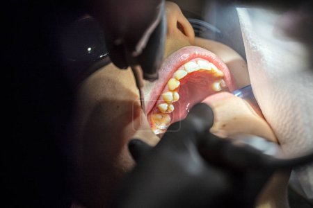 Foto de Dentista utiliza un instrumento especial para restaurar un diente de los pacientes con un espejo. - Imagen libre de derechos