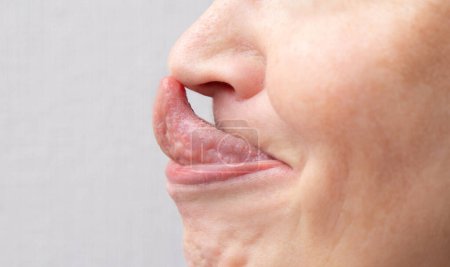 The Gorlin sign is a medical term that indicates the ability to touch the tip of the nose with the tongue. Might be the sign of EhlersDanlos syndrome.